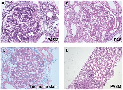 Case report: A case of proliferative glomerulonephritis with monoclonal kappa-light chain deposits treated with daratumumab combination therapy